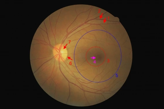 1.視網膜動脈 2.視網膜靜脈 3.視網膜中央凹 4.視網膜中央小凹 5.黃斑部 6.視神經盤 7.視神經杯